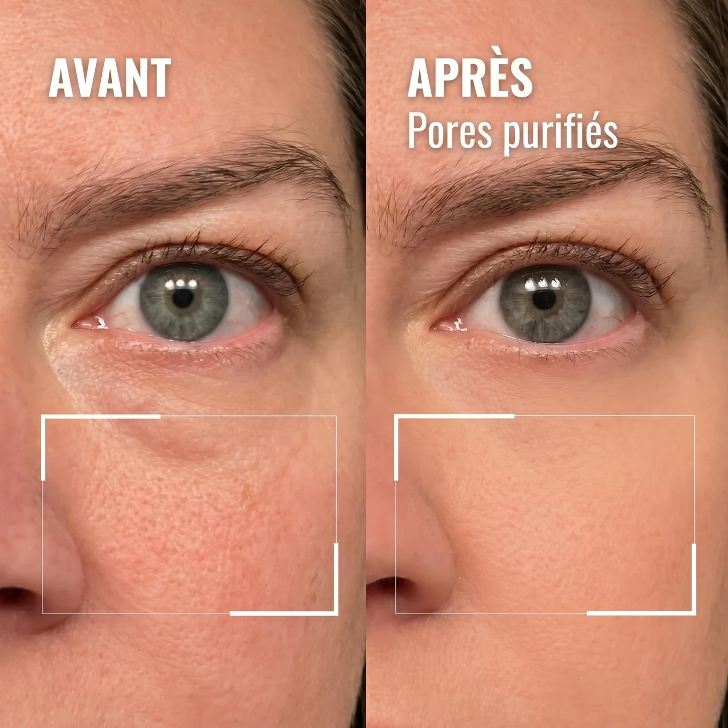Détail du contour de l'œil — avant / après, pores purifiés