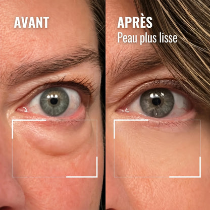 Détail du contour de l'œil — avant / après, peau plus lisse