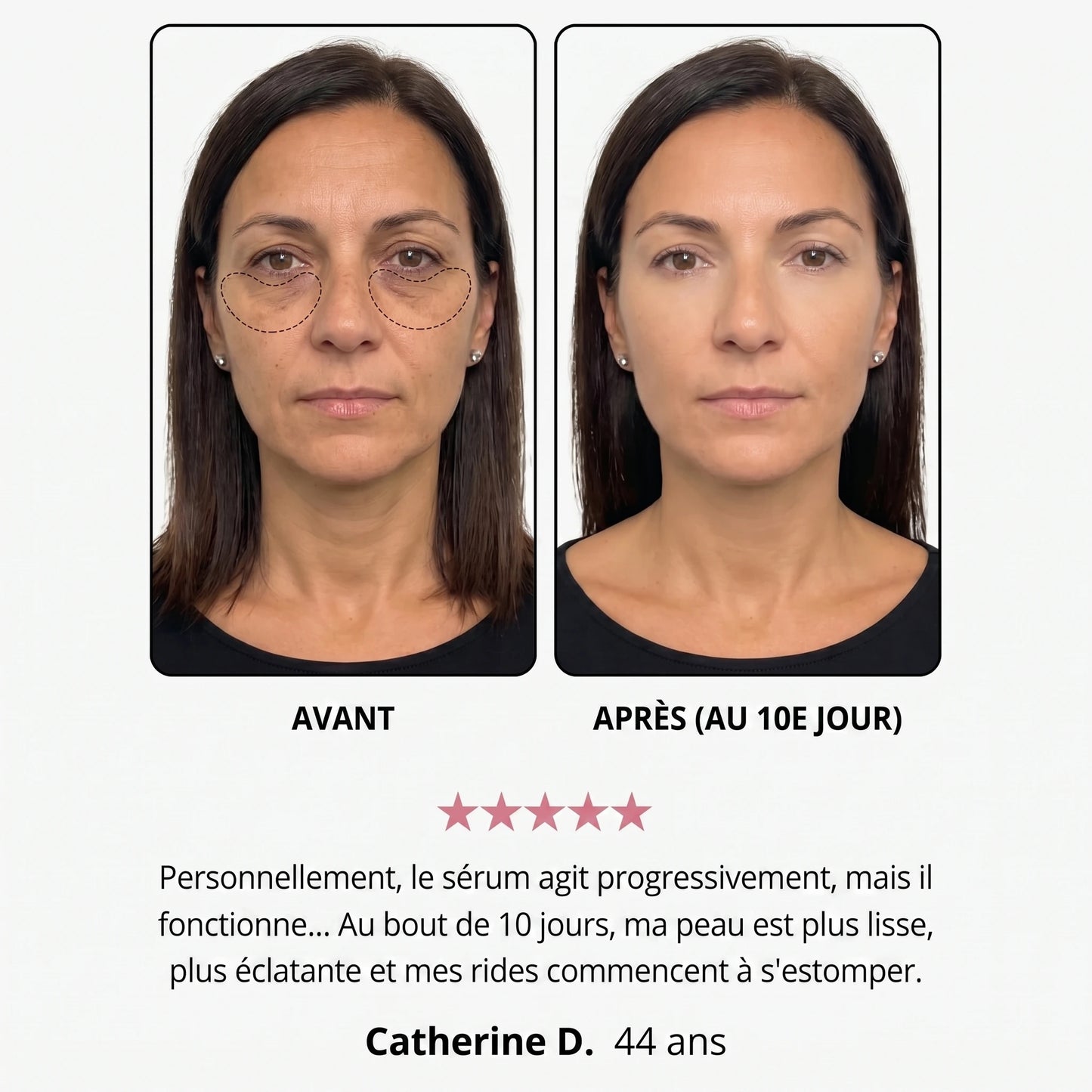 Avant / après — Pauline N., 44 ans, au 10e jour