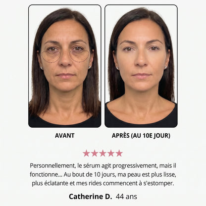 Avant / après — Pauline N., 44 ans, au 10e jour