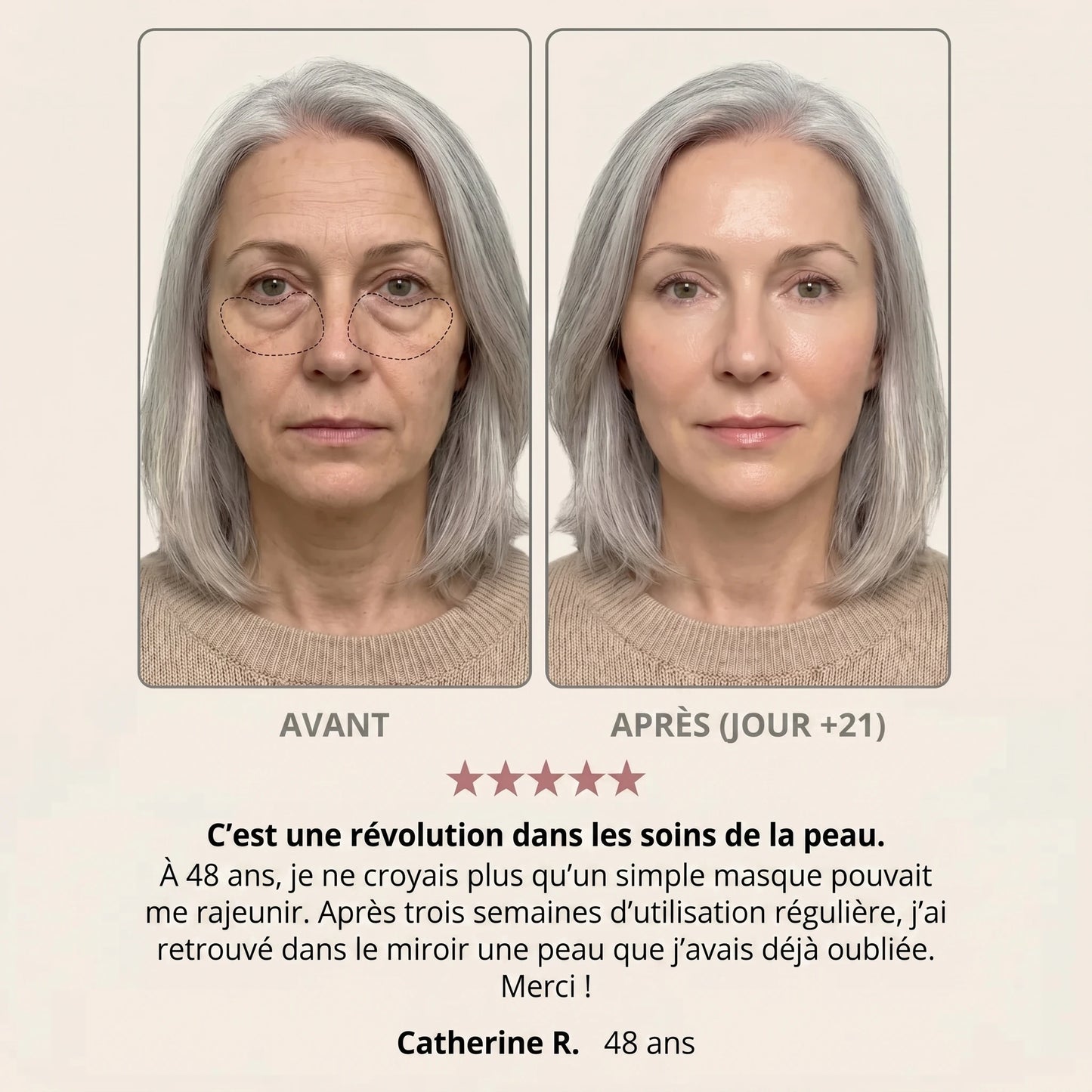 Avant / après — Pauline R., 48 ans, jour +21