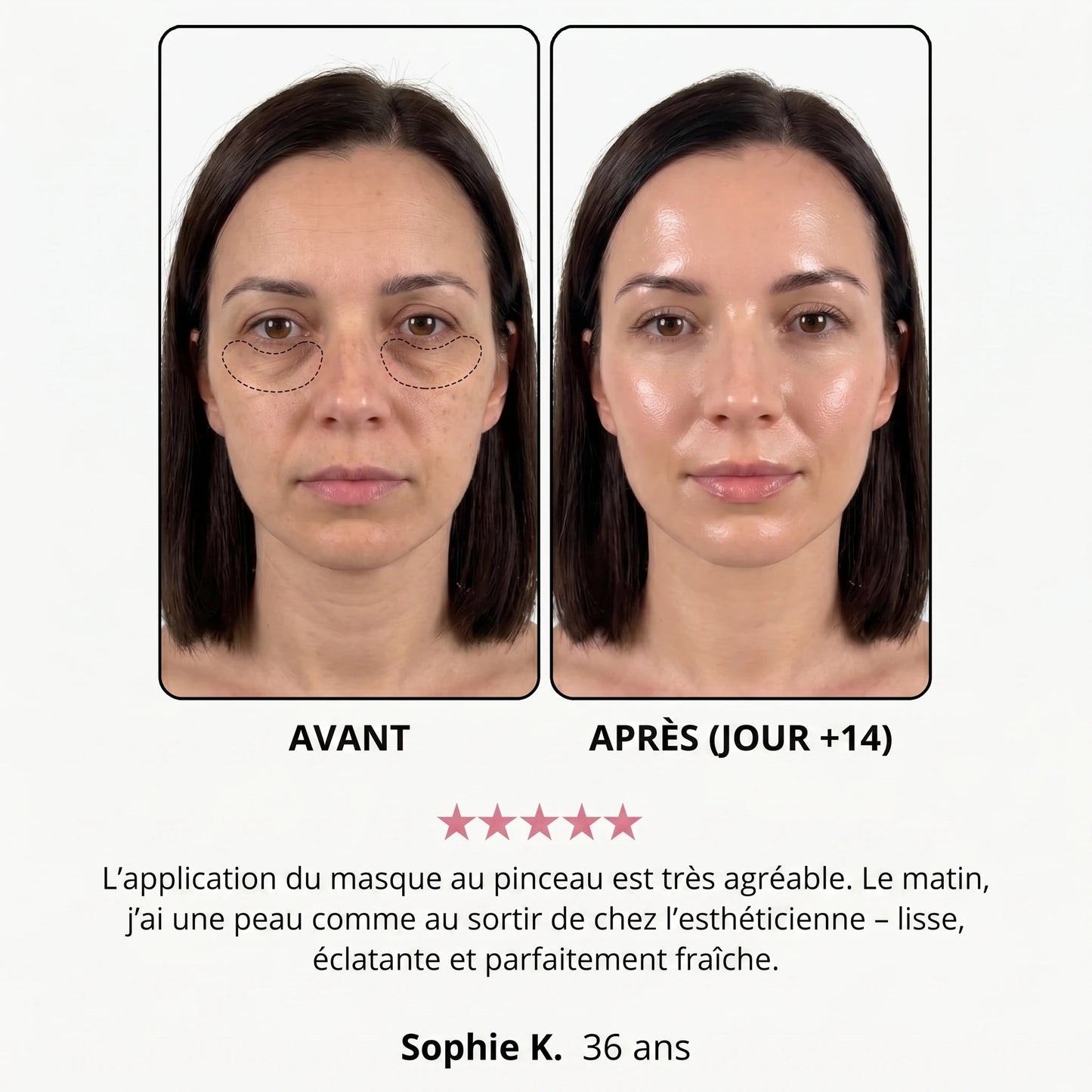 Avant / après — Sophie K., 36 ans, jour +14