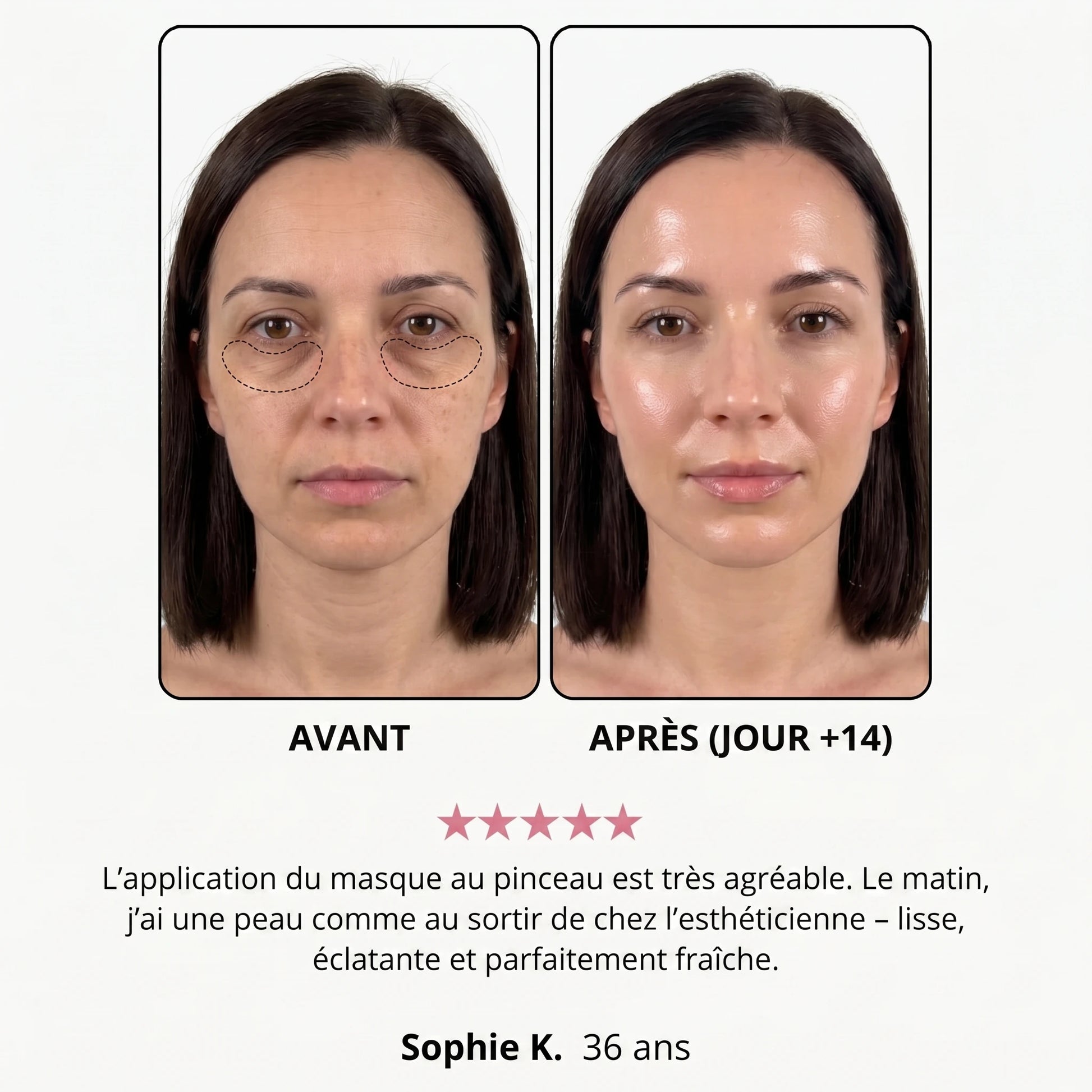 Avant / après — Sophie K., 36 ans, jour +14