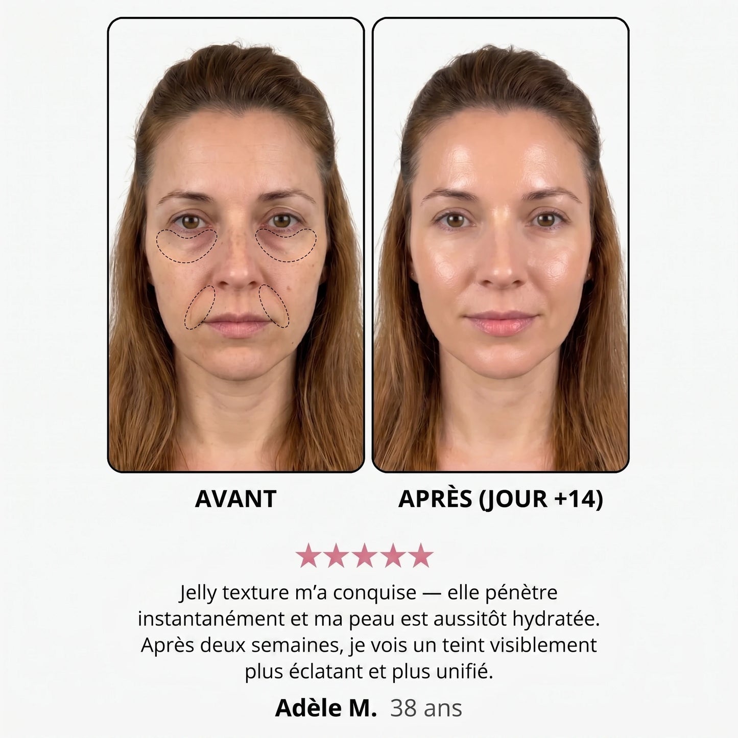 Avant / après — Adèle M., 38 ans, jour +14