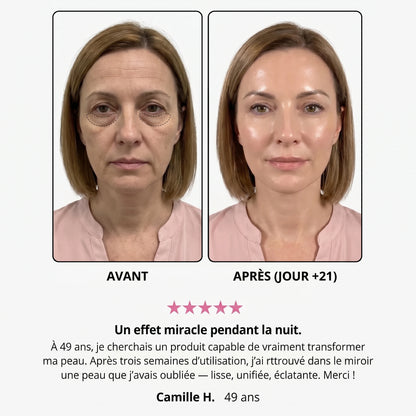 Avant / après — Mathilde H., 49 ans, jour +21