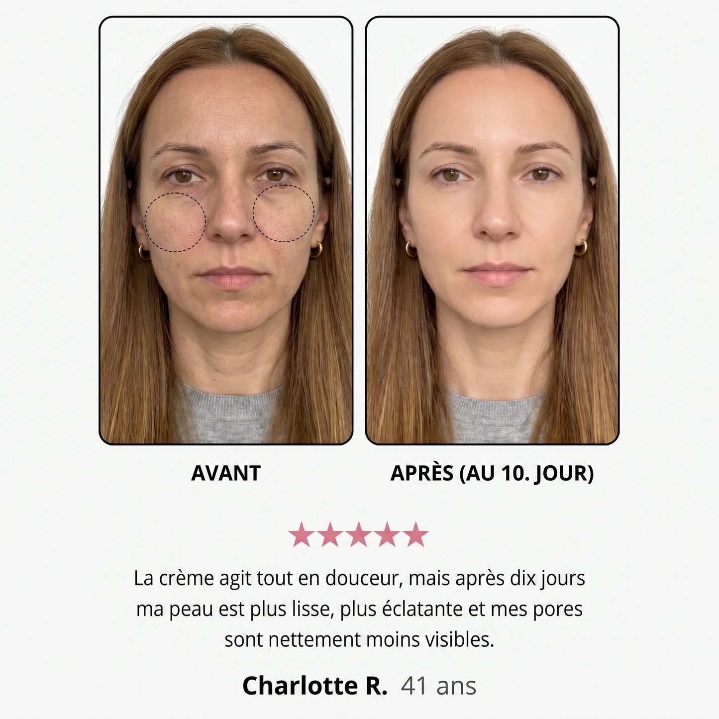 Avant / après — Sandrine R., 41 ans, au 10e jour