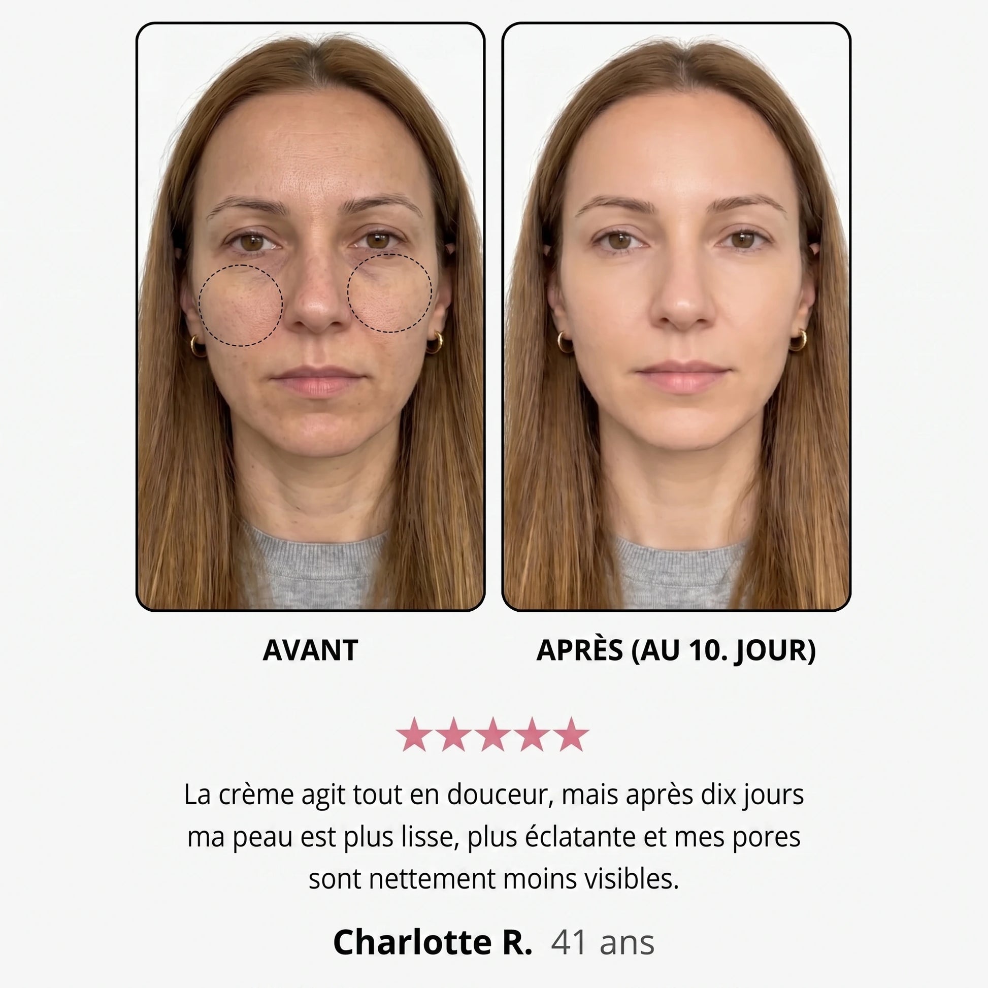 Avant / après — Sandrine R., 41 ans, au 10e jour