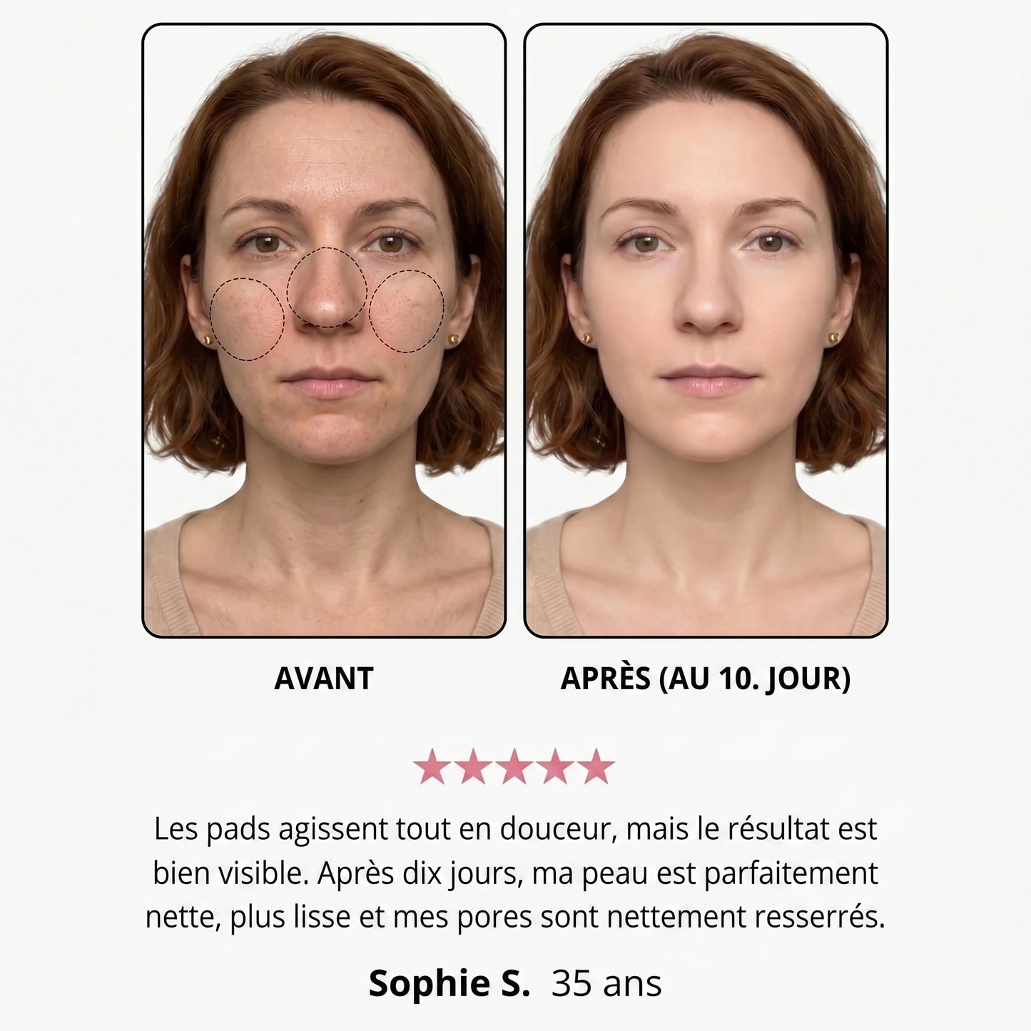Avant / après — Andréa S., 35 ans, au 10e jour