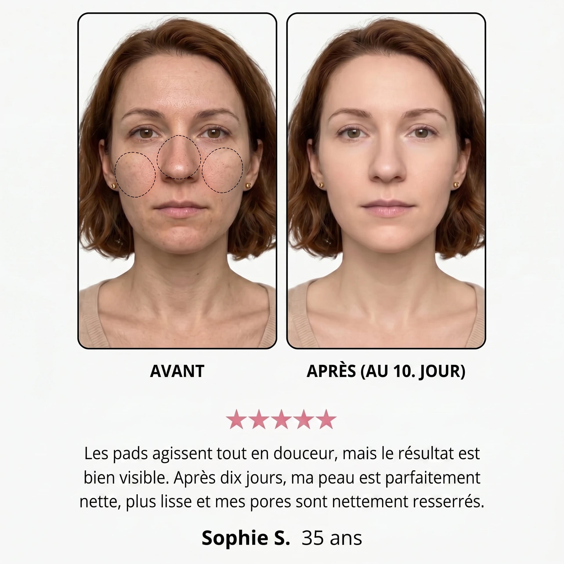 Avant / après — Andréa S., 35 ans, au 10e jour