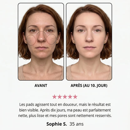 Avant / après — Andréa S., 35 ans, au 10e jour