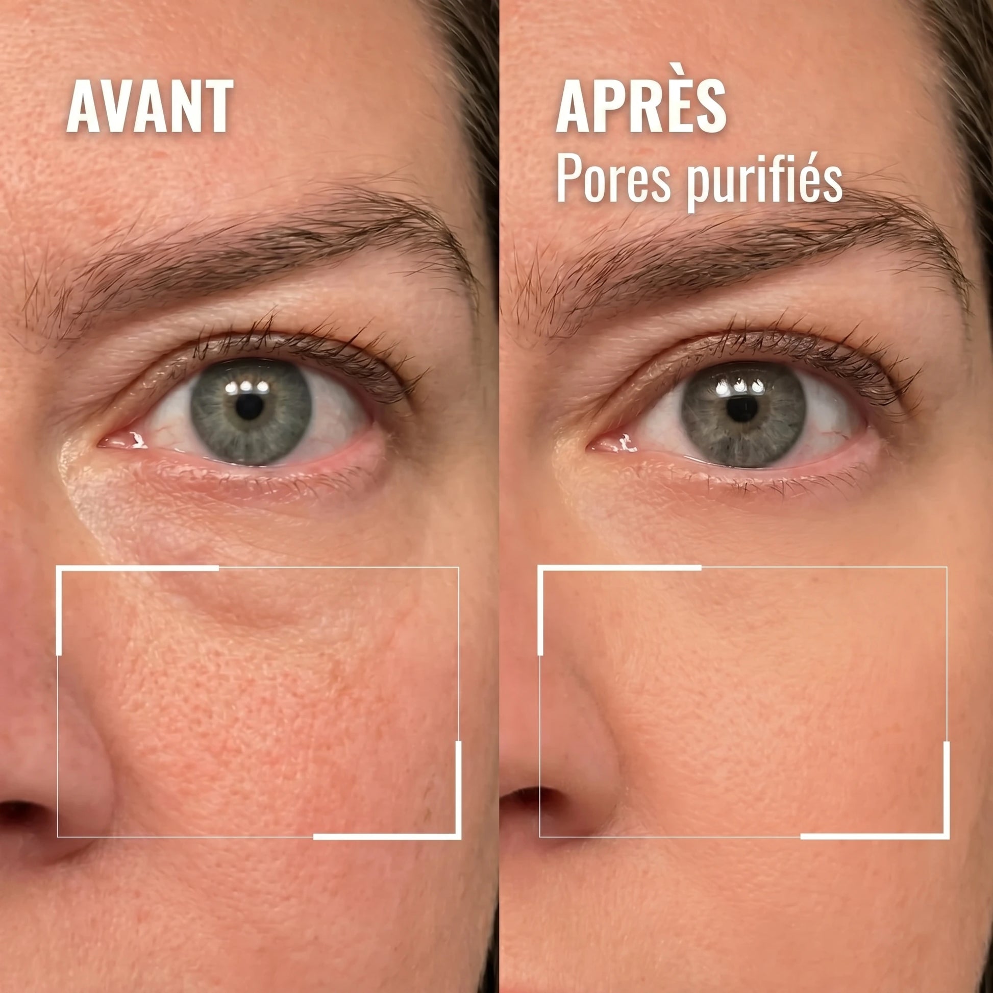 Détail du contour de l'œil — avant / après, pores purifiés