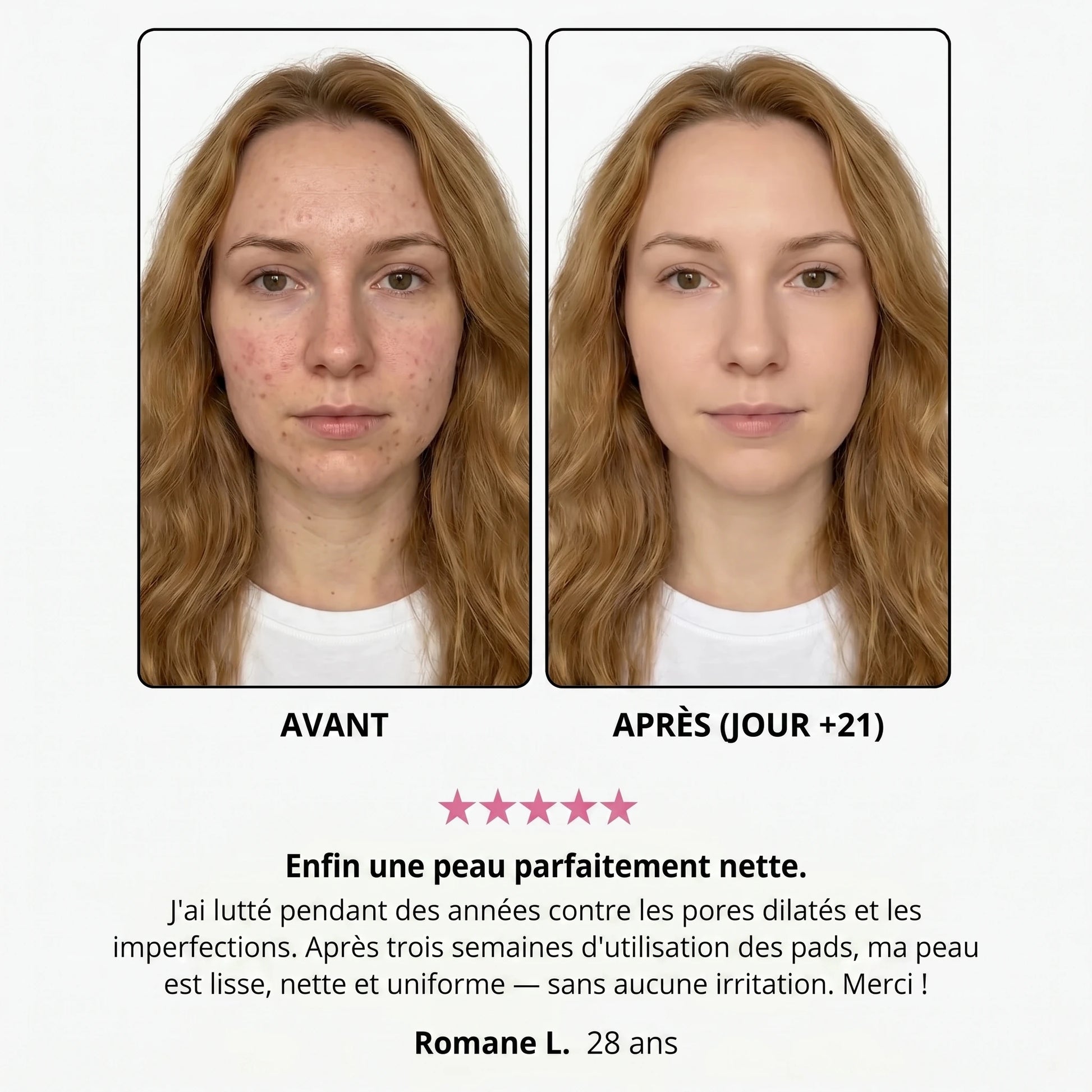 Avant / après — Romane L., 28 ans, jour +21