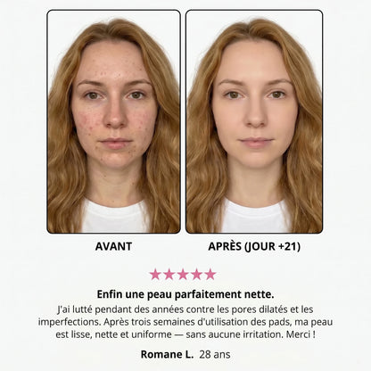 Avant / après — Romane L., 28 ans, jour +21