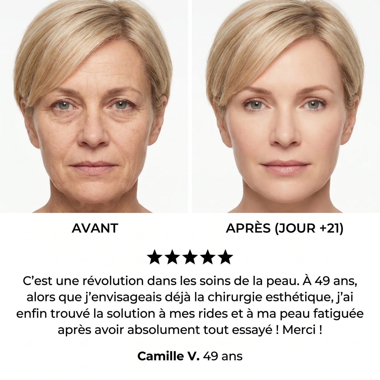Avant / après — Thérèse V., 49 ans, jour +21
