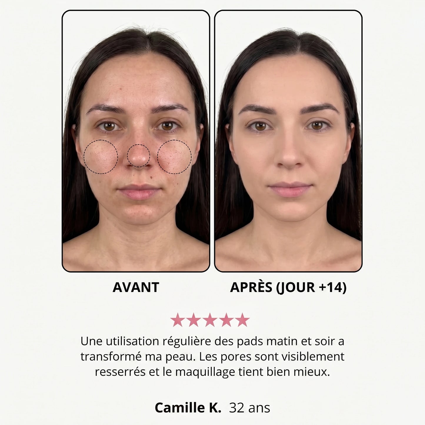 Avant / après — Olivia K., 32 ans, jour +14