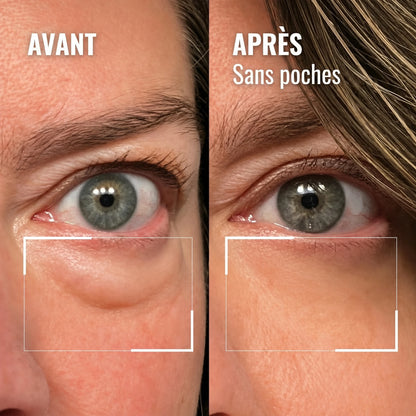 Avant / après — contour des yeux sans poches