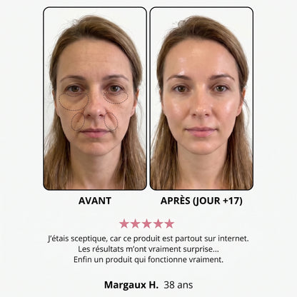 Avant / après — Margaux H., 38 ans, jour +17