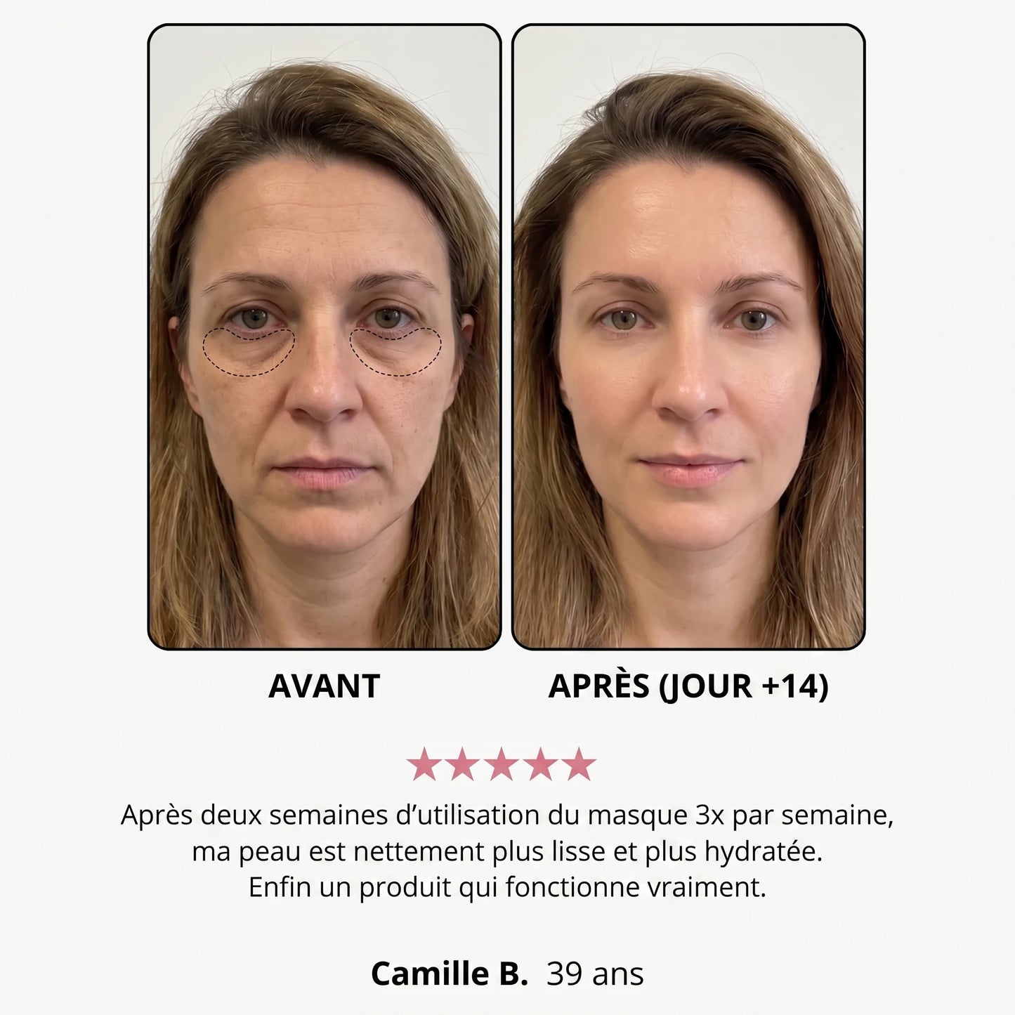 Avant / après — Léa B., 39 ans, jour +14